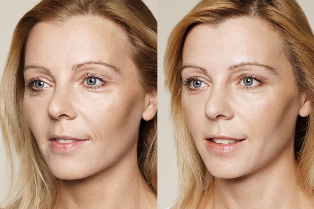 Expérience utilisateur avant et après utilisation de la crème intenskin de Valeria